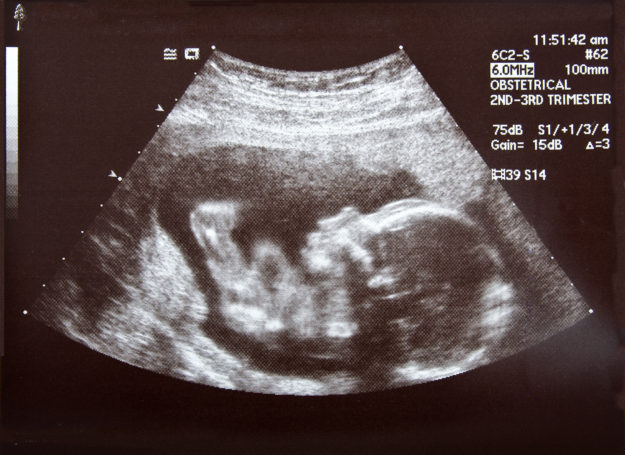 Ultrasound during second trimester